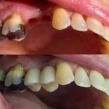 Before and after dental implant case 1