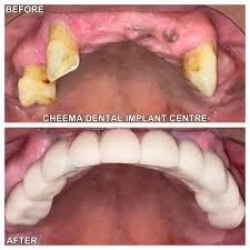 Before and after dental implant case 2