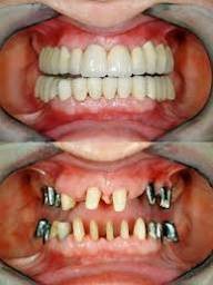 Before and after dental implant case 4